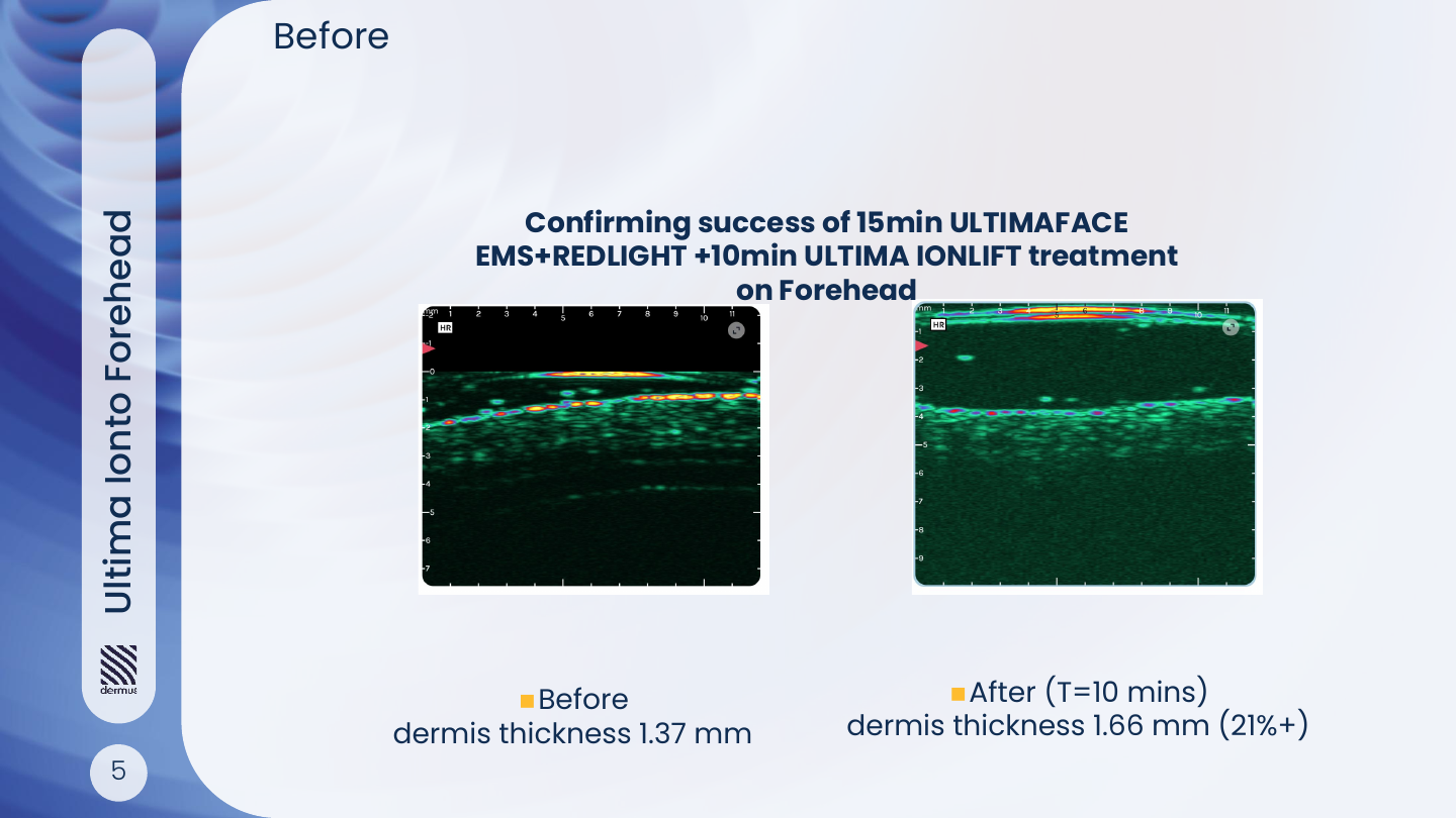 Forehead measurement: A selected before/after example: 1.37 mm to 1.66 mm. After the combined ULTIMAFACE + IonLift protocol. The original paired ultrasound panels are reproduced together. Source: Dermus report, p. 7.