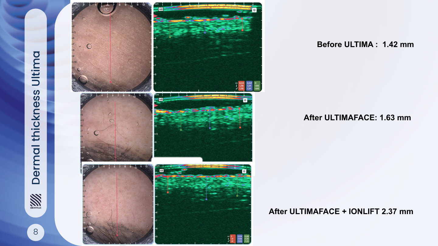 A three-stage observation: Baseline 1.42 mm → after ULTIMAFACE 1.63 mm → after ULTIMAFACE + IonLift 2.37 mm. One selected sequence, not a group average. Source: p. 9, figure 6.